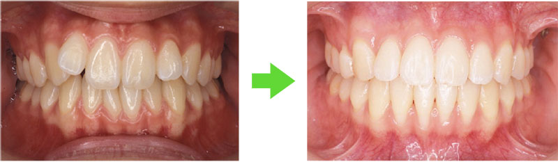 歯茎が下がるイメージ
