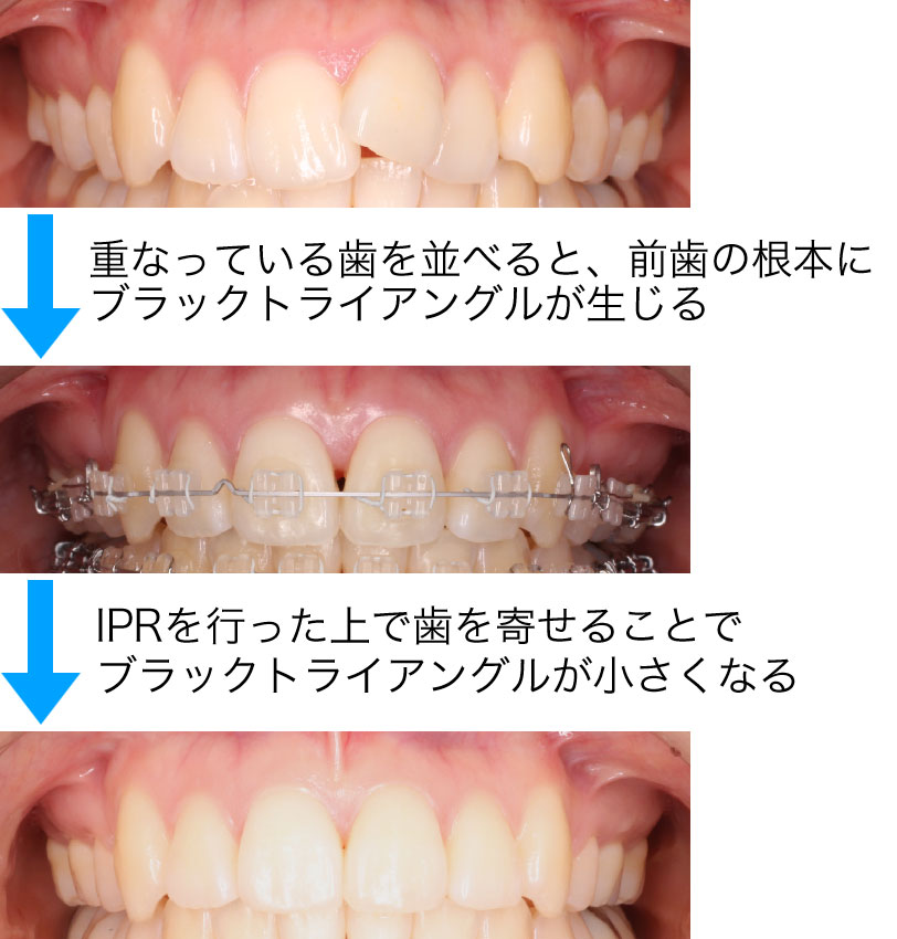 隙間が小さくなった