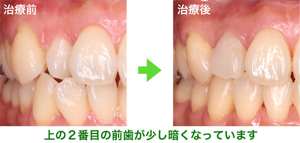 上の番目の前歯が少し暗くなったイメージ