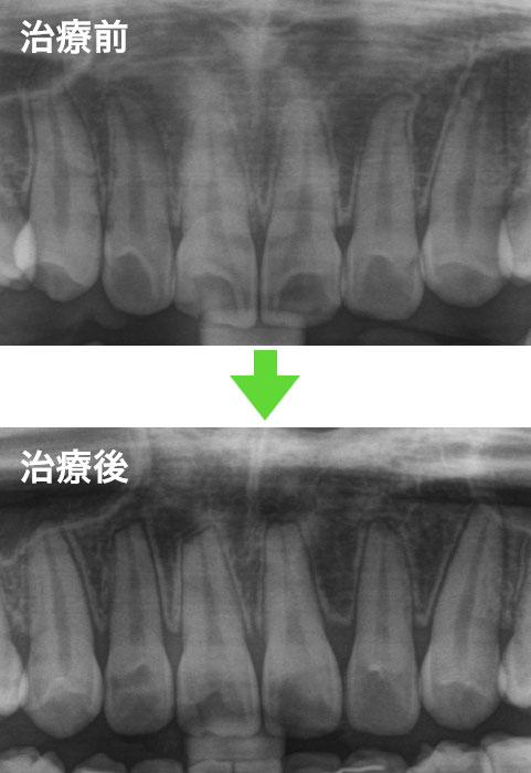 歯根吸収のイメージ