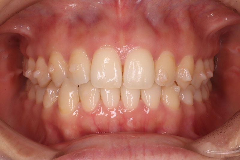 アタッチメント