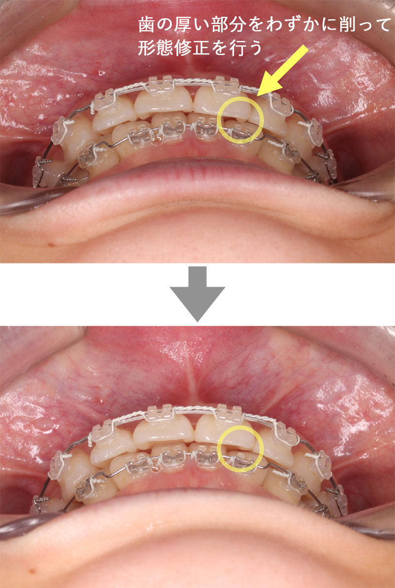 歯の厚い部分をわずかに削って形態修正を行う